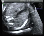 Fetal cardiac scanning