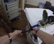 This video shows, first person, the process of placing a KTD splint from beginning to end.