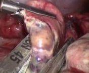 Gerald Schell MD is profesionalin neurological surgeryand have an experience in field such as back pain ,brain cancer .Gerald Schell MD has found andposted this video to show appendixsurgery to explain how to perform a laparoscopic appendectomy for a ruptured appendix.