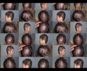 Timea hade en stor kal zon längst upp på huvudet, men på ett diffust sätt. Det var en stor utmaning, för hennes hår började bli grått. Bilderna visar att man kan utföra en hårtransplantation med gott resultat för grått hår. Denna film innehåller före- och efterbilder för hårtransplantationen.nnhttps://www.facebook.com/H%C3%A5rtransplantation-Clinic-Phaeyde-409490819243377/nhttp://sv.phaeyde.com/har-implantation