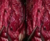 Video 1. Three-dimensional operative video of an example case demonstrating use of pedicled TPFF in combined revascularization with STA-MCA bypass. Copyright Jonathan J. Russin. Published with permission.nhttps://thejns.org/doi/abs/10.3171/2018.5.JNS18938