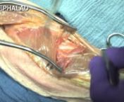 Posterior Plating of the Humeral Diaphysis - Raymond Pensy, MD from pensy