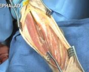 Anterolateral Plating of the Humeral Diaphysis - Raymond Pensy, MD from pensy