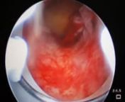 Hysteroscopy is a procedure to examine the uterus internally using a camera. In this procedure, a flexible tube fixed with a small light and camera called a hysteroscope is inserted into the uterus via the cervix and vagina to see the uterus internally.
