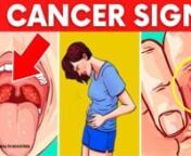 ➤ Recommended products for Health [100% Safe] :n� Immune Support : https://cutt.ly/ImmuneSupportOfficialStor-acess- n�Subscribe to Channel: https://bit.ly/2KMETzDnn❤️ Visit our website and read the full article about 12 Cancer Signs: https://dailyhealthboosters.com/nn�[ ALERT !!]12 CANCER SIGNS Mostly Ignored By Women�nnnWelcome to the Daily Health Boosters channel. Today we are going to talk about the 12 Signs of Cancer, Mostly Ignored by Women. If this subject interests y