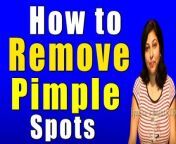 #pimples #acnescars #fairskin&#60;br/&#62;&#60;br/&#62;Try this effective home remedy to remove the pimple spots.&#60;br/&#62;&#60;br/&#62;Require:&#60;br/&#62;1. potato&#60;br/&#62;2. cucumber &#60;br/&#62;3. lemon juice &#60;br/&#62;4. bengal gram flour (besan) &#60;br/&#62;&#60;br/&#62;Preparation:&#60;br/&#62;1. grate potato and cucumber&#60;br/&#62;2. take 1 teaspoon grated potato in a bowl&#60;br/&#62;3. add to it 1 teaspoon grated cucumber&#60;br/&#62;4. add 1 teaspoon lemon juice&#60;br/&#62;5. add 1 teaspoon bengal gram flour&#60;br/&#62;6. mix all the items properly&#60;br/&#62;&#60;br/&#62;Application:&#60;br/&#62;1. apply this mixture on face &#60;br/&#62;2. leave it for 15 minutes&#60;br/&#62;3. when dry remove the paste&#60;br/&#62;4. wash the face with cold water&#60;br/&#62;&#60;br/&#62;In this video our very talented, beautiful TV and Movie Actress &amp; Heath &amp; beauty Expert Mrs Priyanka Saini is telling &#92;