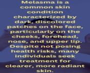 #shorts A recipe for treating melasma skin naturally&#60;br/&#62;A recipe for treating melasma skin naturally &#124; Treating skin melasma naturally &#124; Melasma &#124; Best treatment for melasma on the face&#60;br/&#62;Looking for the best natural treatment for melasma without hydroquinone? In this video, we discuss the most effective natural remedies for treating melasma in 2024. Say goodbye to dark patches on your skin with these safe and natural alternatives. Watch now to learn more about the best natural melasma treatment options available!&#60;br/&#62;-----------------&#60;br/&#62;To learn more&#60;br/&#62;https://www.mixinfo22.com/2024/05/melasma-home-treatment.html&#60;br/&#62;&#60;br/&#62;To buy the products&#60;br/&#62;https://sites.google.com/view/melasma-best-melasma-treatment/home&#60;br/&#62;&#60;br/&#62;To support our channel on PayPal&#60;br/&#62;https://www.paypal.com/paypalme/amirahamdon442&#60;br/&#62;-----------------&#60;br/&#62;Other videos&#60;br/&#62;Filtering the liver from toxins&#60;br/&#62;https://www.youtube.com/shorts/GqWZ5rhfjKk&#60;br/&#62;&#60;br/&#62;Large pores Myths&#60;br/&#62;https://youtu.be/1QzbhB82EO4&#60;br/&#62;&#60;br/&#62;The radical solution for pigmentation&#60;br/&#62;https://youtu.be/hiAqLclhMJ0&#60;br/&#62;-----------------&#60;br/&#62;Website&#60;br/&#62;https://www.mixinfo22.com/&#60;br/&#62;Facebook Page&#60;br/&#62;https://www.facebook.com/mix.information22/&#60;br/&#62;Facebook group&#60;br/&#62;https://www.facebook.com/groups/mix22/&#60;br/&#62;Instagram&#60;br/&#62;https://www.instagram.com/mix.information1/&#60;br/&#62;Pinterest&#60;br/&#62;https://www.pinterest.com/mix442/&#60;br/&#62;Quora&#60;br/&#62;https://mixs.quora.com/&#60;br/&#62;Reddit&#60;br/&#62;https://www.reddit.com/r/mix_info1/&#60;br/&#62;Snapchat&#60;br/&#62;https://www.snapchat.com/add/mix44222&#60;br/&#62;Tiktok&#60;br/&#62;https://www.tiktok.com/@mix44222&#60;br/&#62;Tumblr&#60;br/&#62;https://www.tumblr.com/blog/mix442&#60;br/&#62;Twitter&#60;br/&#62;https://twitter.com/mix44222&#60;br/&#62;Pets Birds Site&#60;br/&#62;https://www.petsbirds1.com/&#60;br/&#62;With herbs site&#60;br/&#62;https://www.naherbs.com/&#60;br/&#62;------------------&#60;br/&#62;A recipe for treating melasma skin naturally #mix #SkinCare2024