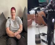 Heartwarming video shows a woman born with one arm operating bionic hand for the first time - before it&#39;s even been fitted to her arm.&#60;br/&#62;&#60;br/&#62;Julie Norwood, 53, was born missing her lower left arm and hand.&#60;br/&#62;&#60;br/&#62;She never let it hold her back - and found alternative ways to do everyday tasks such as driving and cooking by relying on her right hand.&#60;br/&#62;&#60;br/&#62;But the mum-of-two, from Broadstairs, Kent, began to develop arthritis in 2020.&#60;br/&#62;&#60;br/&#62;Her right hand is now unable to grip and prevents her from doing lots of things - including administering her important medication for her type one diabetes.&#60;br/&#62;&#60;br/&#62;She was put in touch with Open Bionics last month and got to try a pioneering bionic &#39;hero arm&#39;.&#60;br/&#62;&#60;br/&#62;Despite never having operated a bionic arm before, she got the hang of it almost instantly.&#60;br/&#62;&#60;br/&#62;Sweet video footage shows an amazed Julie moving the fingers using the sensors - before the hand was even put on her arm.&#60;br/&#62;&#60;br/&#62;Now Julie, who works as a checkout assistant, is trying to raise £20,000 so she can have a hero arm of her own.&#60;br/&#62;&#60;br/&#62;She said: &#92;