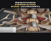 Removing Herniated Disc Surgery 3D Animation