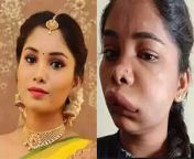 After Chethana Raj’s fatal plastic surgery, now Swathi Sathish’s root canal surgery goes wrong, Kannada actress looks unrecognisable with swollen face.Watch Out &#60;br/&#62; &#60;br/&#62;#SwathiSathish #WrongRootCanalSurgery #KannadaActressSwathi