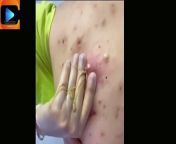 Get ready to cringe and squirm as we delve into the realm of the grossest pimple-popping moments ever captured on camera! If you have a strong stomach and a morbid curiosity for the grotesque, then this video is a must-watch. But be warned: these pimple-popping moments are not for the faint of heart. Viewer discretion is advised!