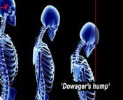 “Poor posture over time” can often cause a hunchback, clinically known as kyphosis. Many may also know this as a dowager’s hump. Your slouching workplace posture could be putting you at risk. Veuer’s Chloe Hurst has the story!